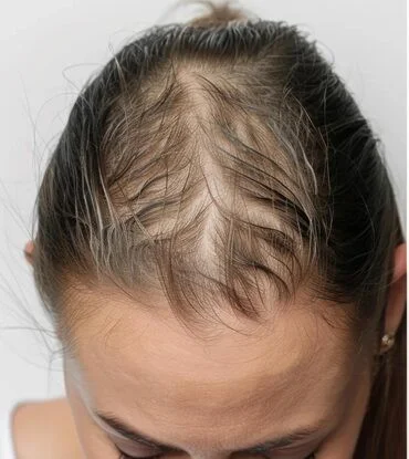 Before PRP Hair Therapy at Varadhi Hair N Glow